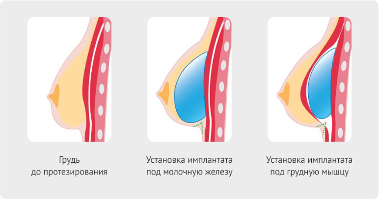 Фото Увеличения Груди Имплантами